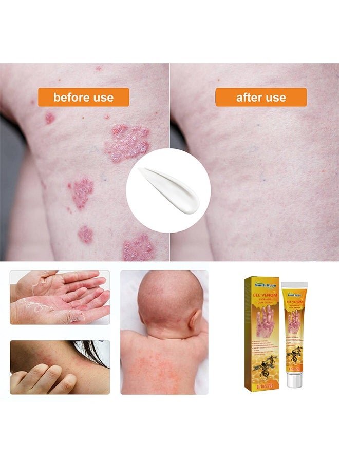 South Moon Bee Venom Psoriasis Cream for Itch & Flare-Up Relief | Natural Skin Soothing